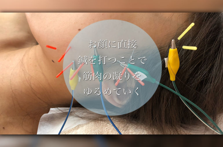歯ぎしりや噛み締めぐせでエラ張りが気になりだしたら